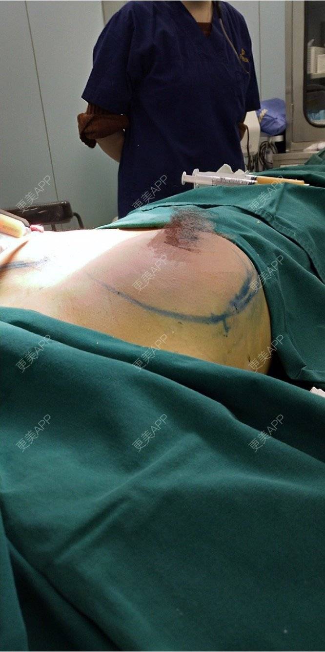 狗屎男人的自体脂肪隆胸日记