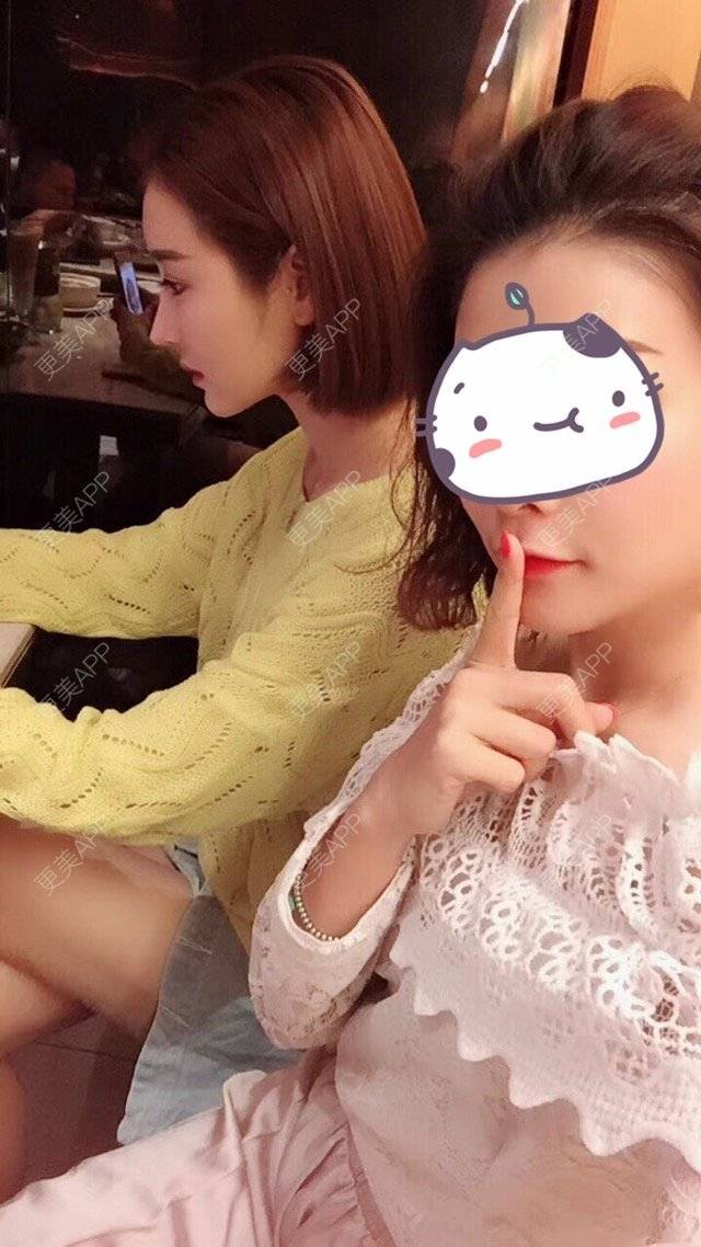 更美 - 莹莹D緈諨的鼻部多项经验 | 视频日记 | 自体软骨隆鼻 | 鼻部多项 | 膨体隆鼻 | 广州 | 驼峰鼻矫正 | 鼻形态修复