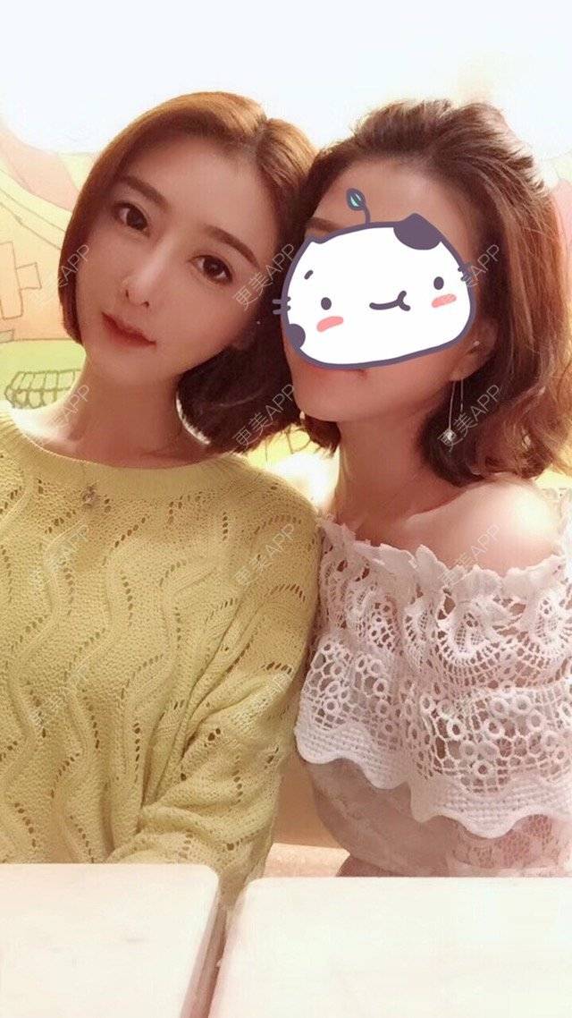 更美 - 莹莹D緈諨的鼻部多项经验 | 视频日记 | 自体软骨隆鼻 | 鼻部多项 | 膨体隆鼻 | 广州 | 驼峰鼻矫正 | 鼻形态修复