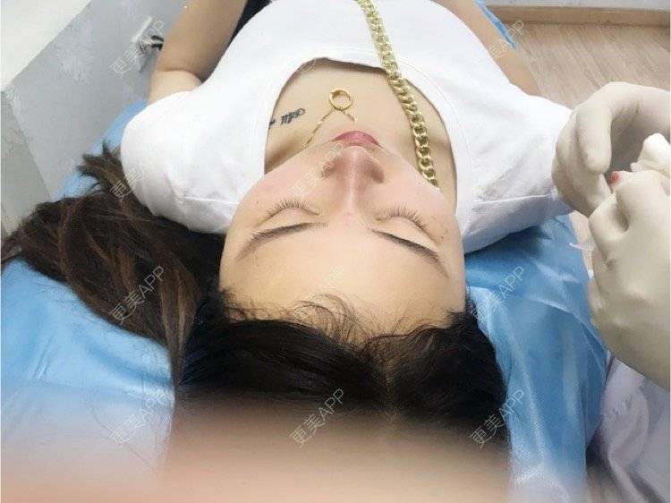 更美 - 更美用户yKJHAqoAC6的玻尿酸经验 | 玻尿酸注射鼻子 | 杭州 | 玻尿酸