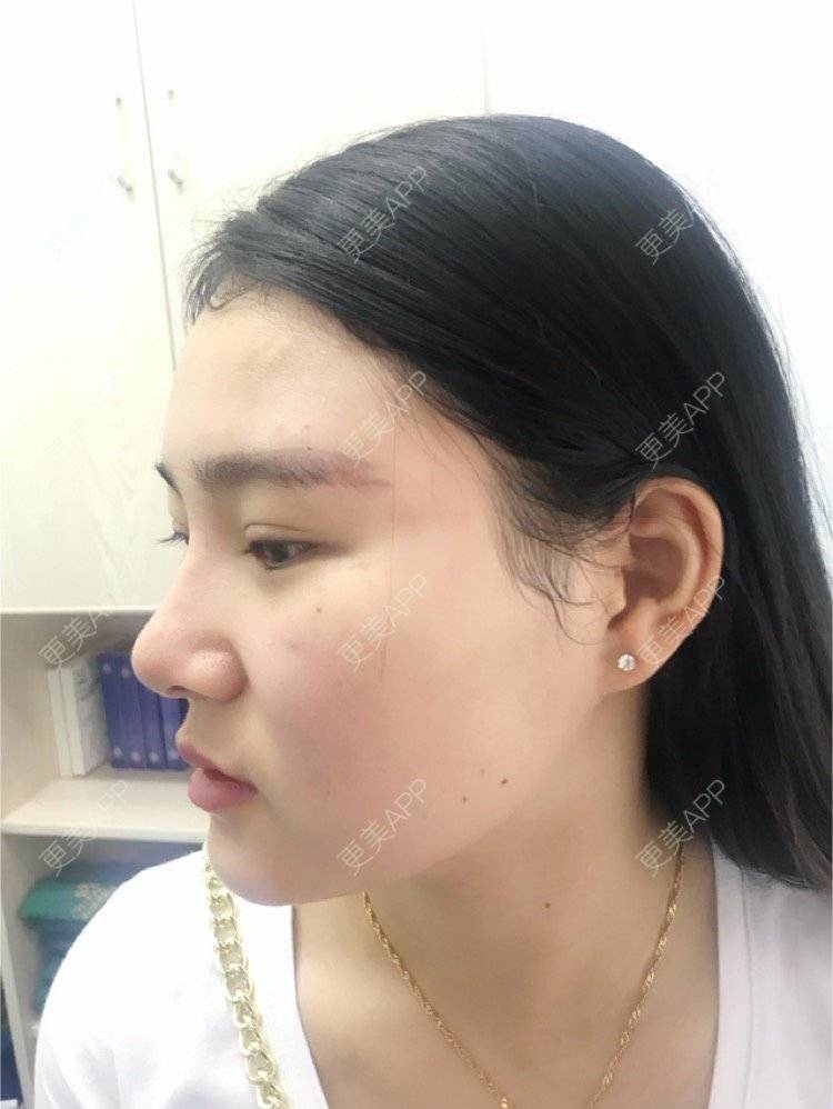 更美 - 更美用户yKJHAqoAC6的玻尿酸经验 | 玻尿酸注射鼻子 | 杭州 | 玻尿酸