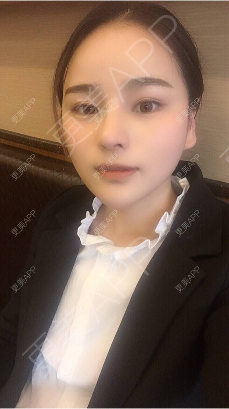 更美 - 更美用户7JqOSIso4n的鼻部多项经验 | 杭州 | 鼻假体取出 | 鼻部多项