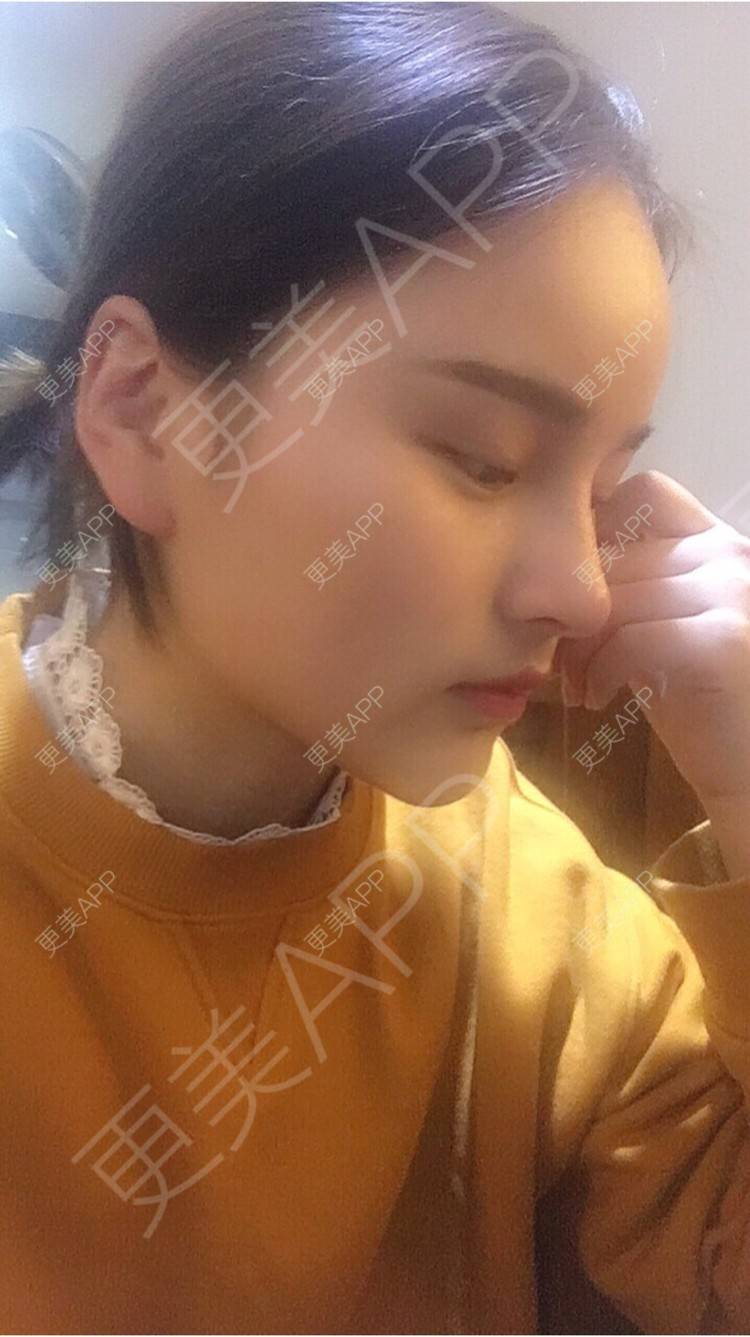 更美 - 更美用户7JqOSIso4n的鼻部多项经验 | 杭州 | 鼻假体取出 | 鼻部多项