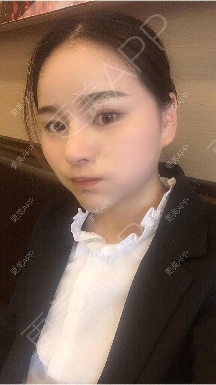 更美 - 更美用户7JqOSIso4n的鼻部多项经验 | 杭州 | 鼻假体取出 | 鼻部多项