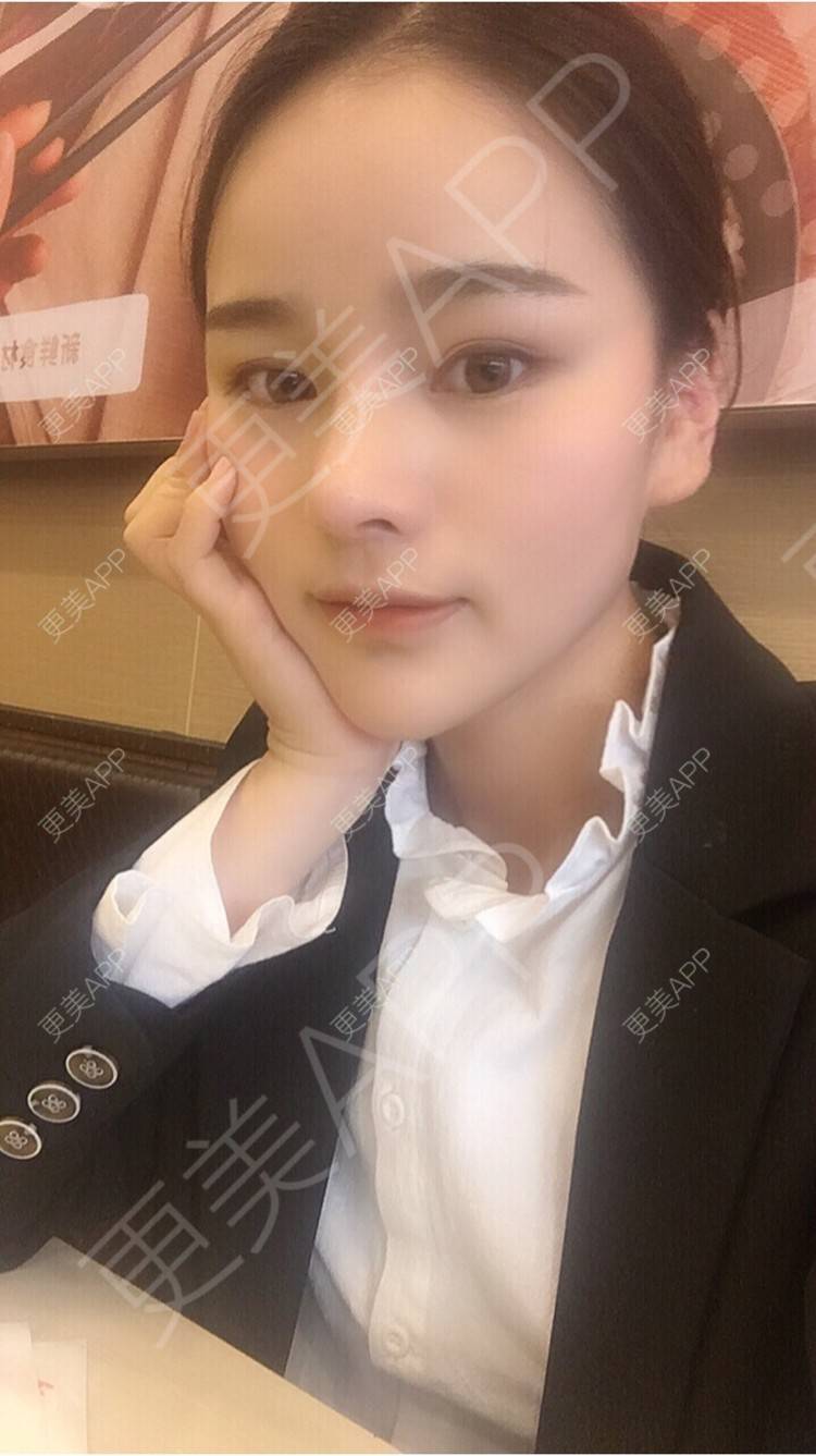 更美 - 更美用户7JqOSIso4n的鼻部多项经验 | 杭州 | 鼻假体取出 | 鼻部多项