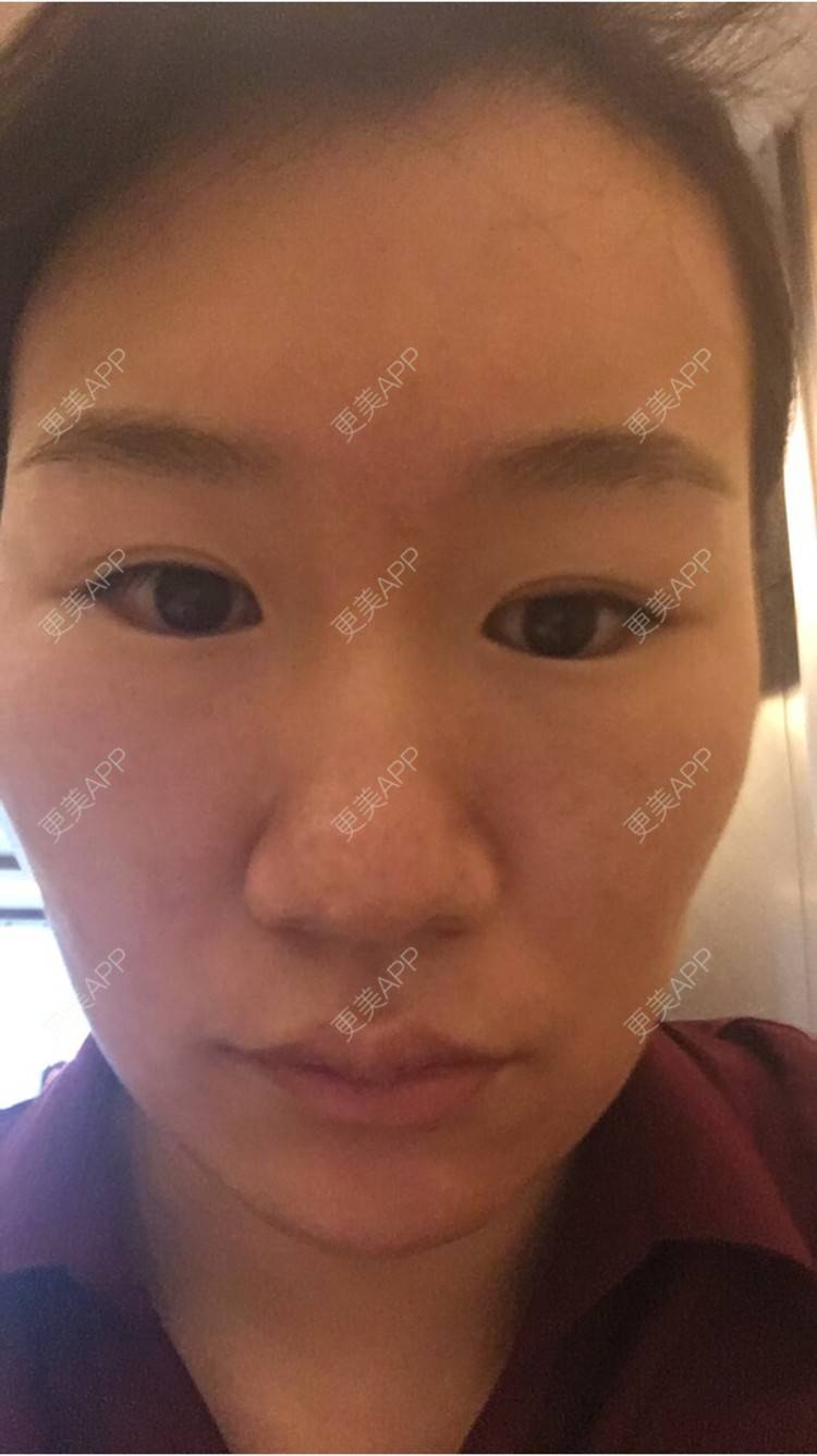 更美 - 更美用户6u2pT0jcqf的淡化皱纹经验 | 注射botox除抬头纹 | 上海 | 淡化皱纹
