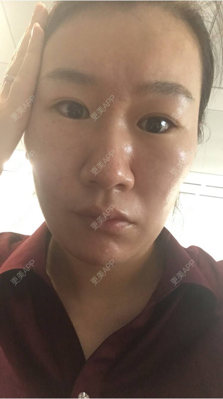 更美 - 更美用户6u2pT0jcqf的淡化皱纹经验 | 注射botox除抬头纹 | 上海 | 淡化皱纹