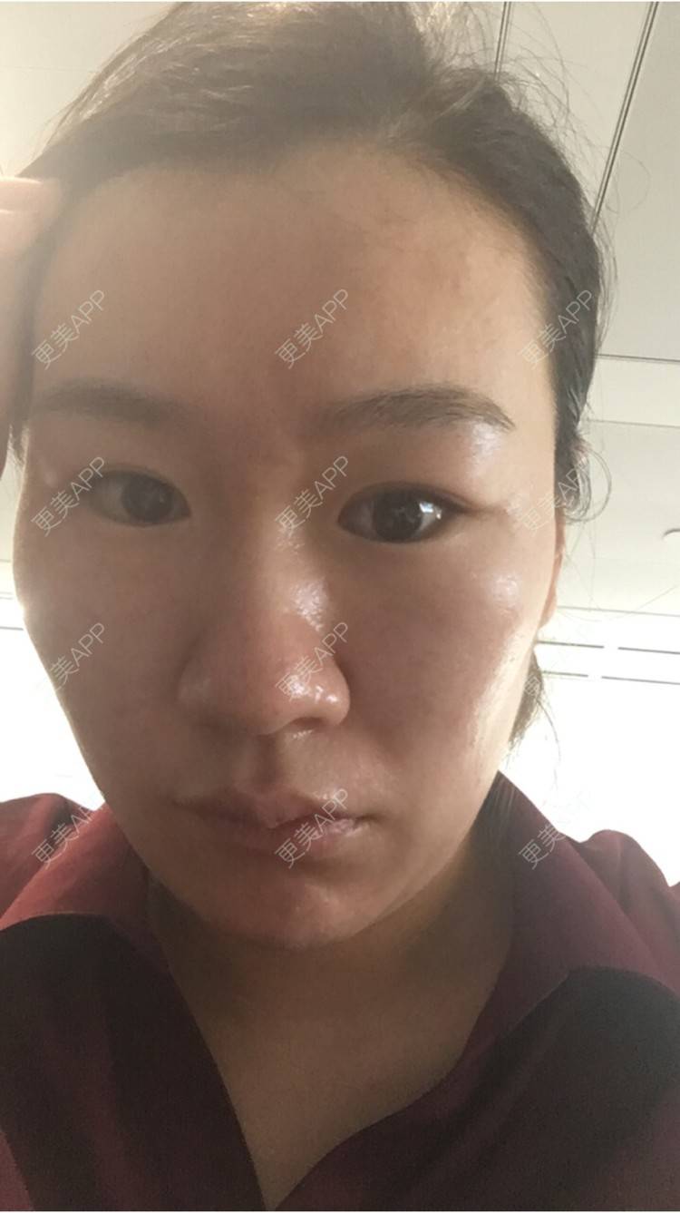 更美 - 更美用户6u2pT0jcqf的淡化皱纹经验 | 注射botox除抬头纹 | 上海 | 淡化皱纹