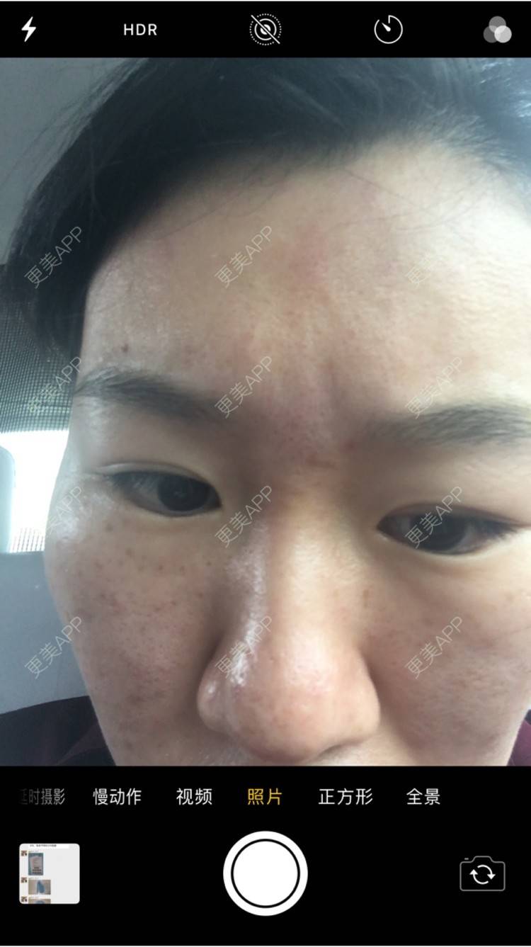 更美 - 更美用户6u2pT0jcqf的淡化皱纹经验 | 注射botox除抬头纹 | 上海 | 淡化皱纹