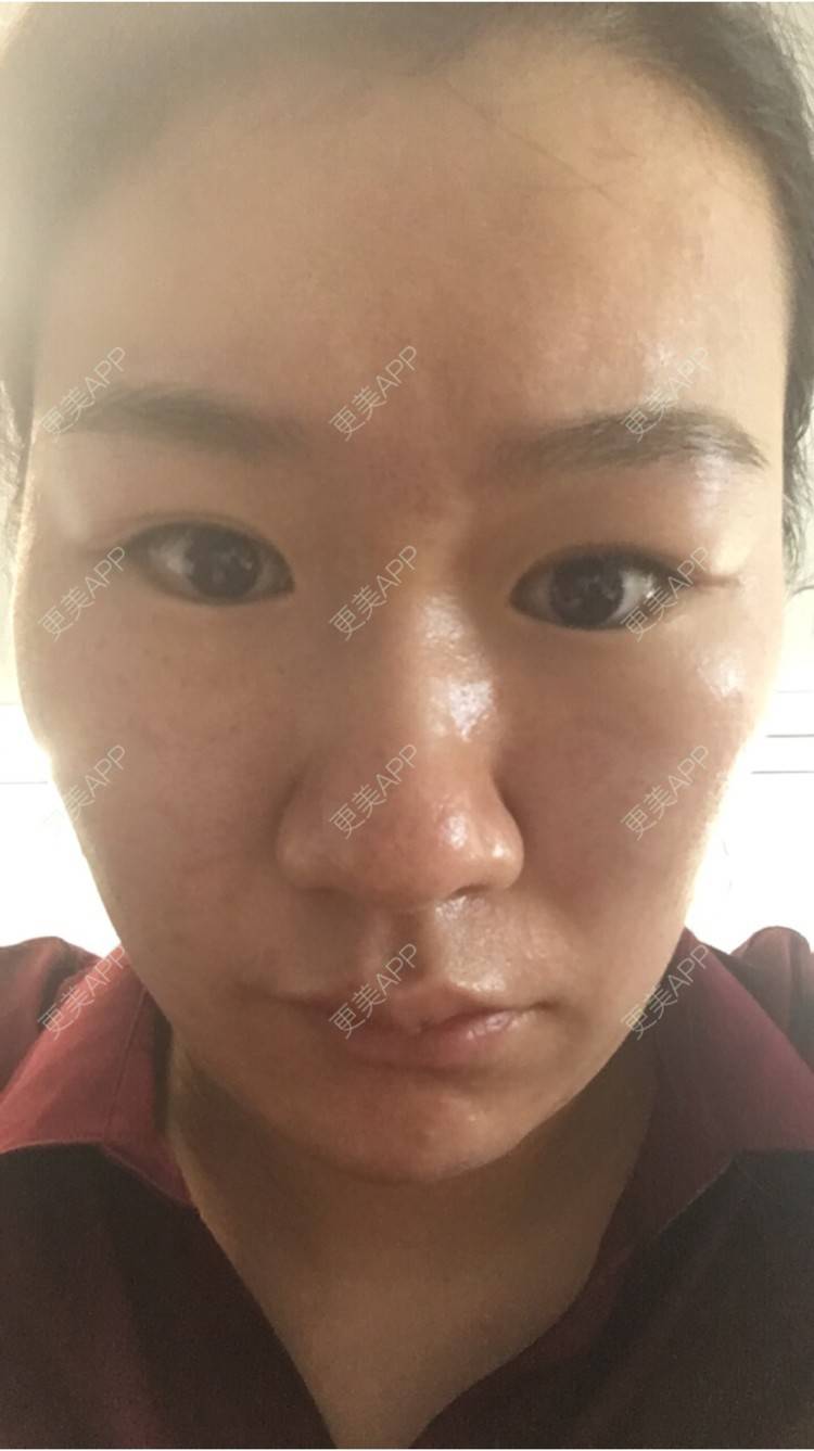 更美 - 更美用户6u2pT0jcqf的淡化皱纹经验 | 注射botox除抬头纹 | 上海 | 淡化皱纹