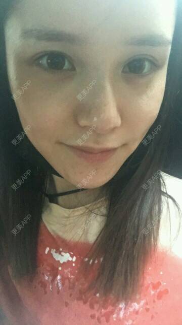 更美 - 请叫我灰姑娘GAO的果酸焕肤经验 | 果酸焕肤 | 南宁