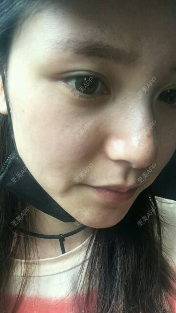 更美 - 请叫我灰姑娘GAO的果酸焕肤经验 | 果酸焕肤 | 南宁