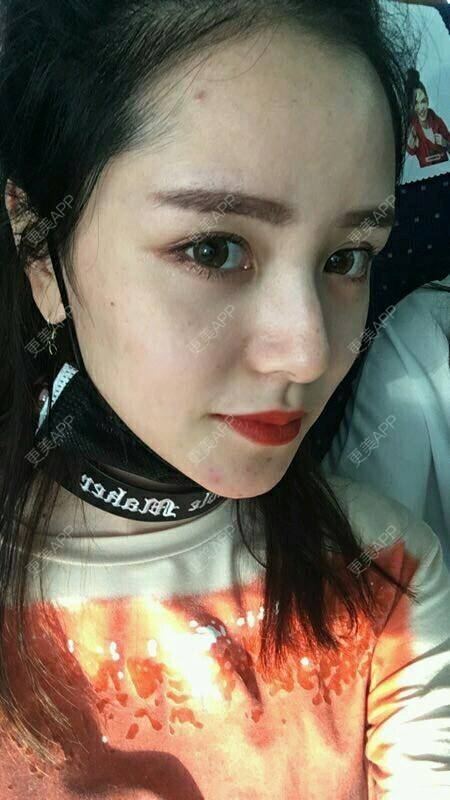 更美 - 请叫我灰姑娘GAO的果酸焕肤经验 | 果酸焕肤 | 南宁