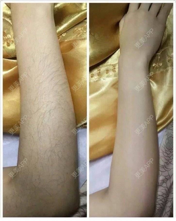 更美 - 潇潇w的激光脱毛日记 | 成都 | 女性私密 | 武汉 | 激光脱毛