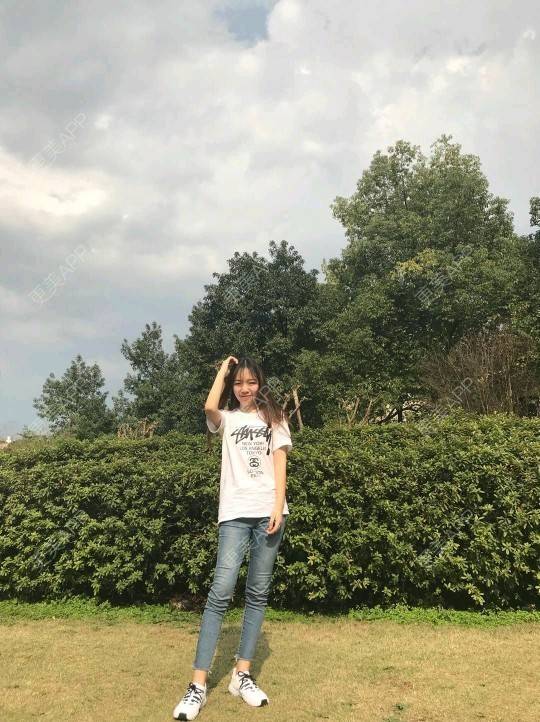 更美 - 三生三世苗媛泻的吸脂瘦大腿经验 | 吸脂瘦大腿 | 长沙