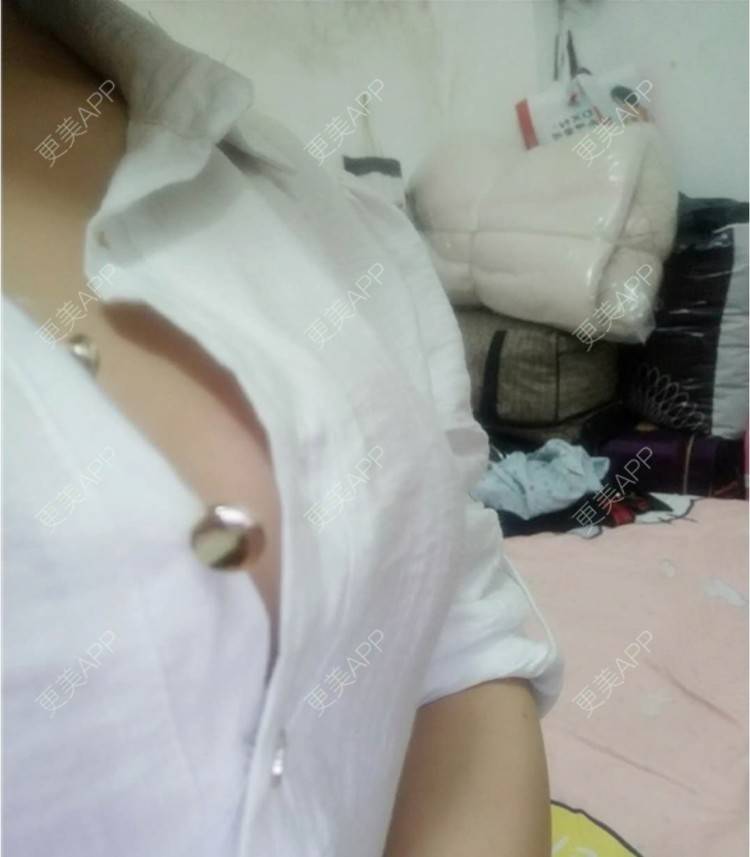 更美 - M公主的缩胸手术经验 | 福州 | 缩胸手术