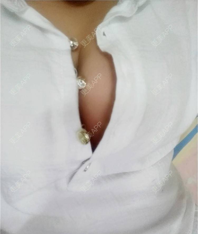 更美 - M公主的缩胸手术经验 | 福州 | 缩胸手术