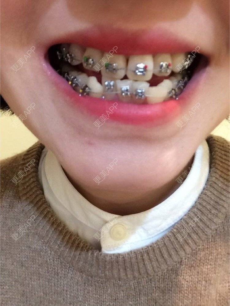 牙齿矫正效果图_更美用户qcnqln189k牙齿矫正效果图_更美