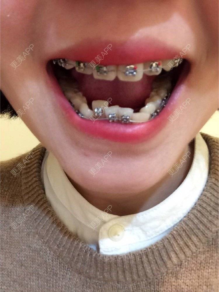 牙齿矫正效果图_更美用户qcnqln189k牙齿矫正效果图_更美