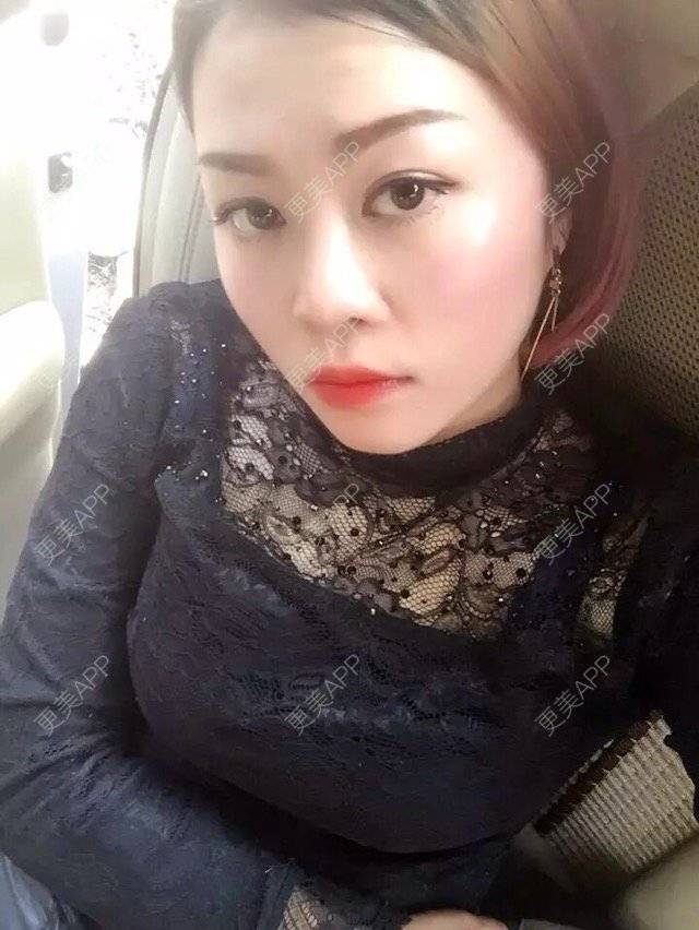 更美 - 幸福You的激光点痣经验 | 激光点痣 | 瘦身美体 | 点痣