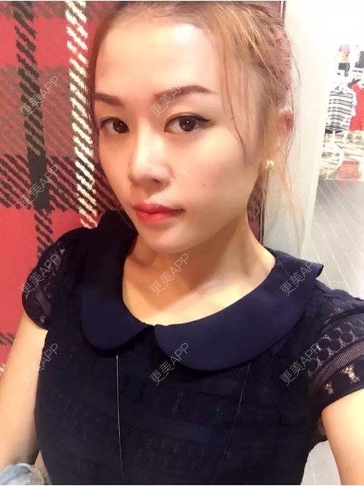更美 - 幸福You的激光点痣经验 | 激光点痣 | 瘦身美体 | 点痣