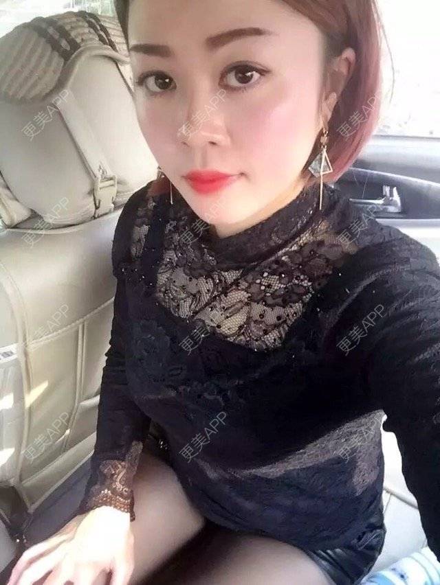 更美 - 幸福You的激光点痣经验 | 激光点痣 | 瘦身美体 | 点痣