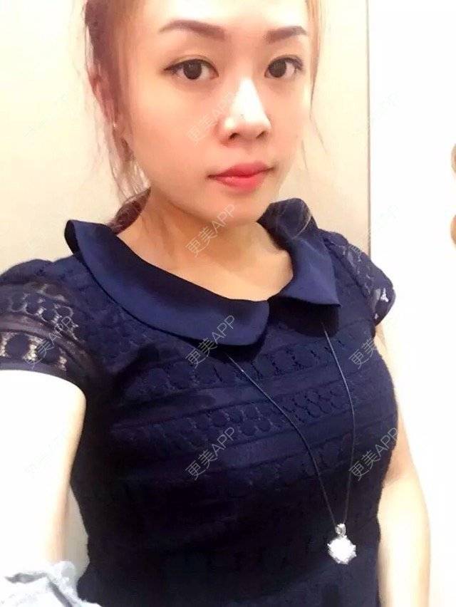 更美 - 幸福You的激光点痣经验 | 激光点痣 | 瘦身美体 | 点痣