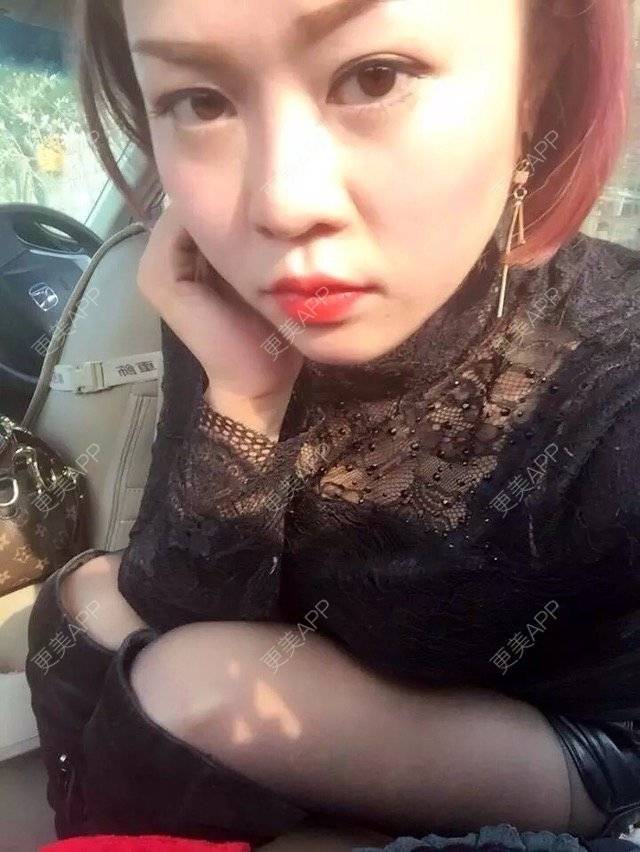 更美 - 幸福You的激光点痣经验 | 激光点痣 | 瘦身美体 | 点痣