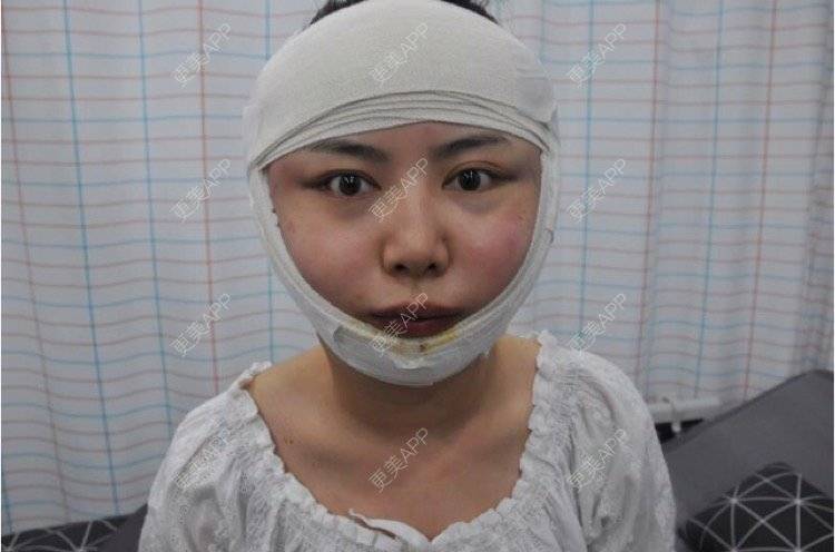 下巴,下巴手术_大世界小姑凉下巴手术_更美整形