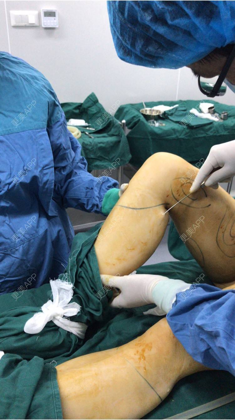 更美 - 神仙姐姐1的吸脂日记 | 全身塑形套餐 | 吸脂 | 武汉