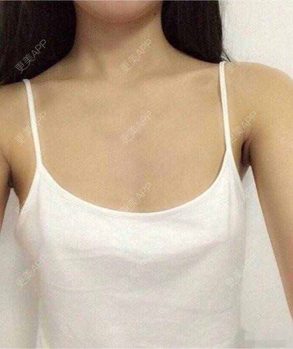 更美 - 薄滨 医生的假体隆胸经验 | 北京 | 假体隆胸