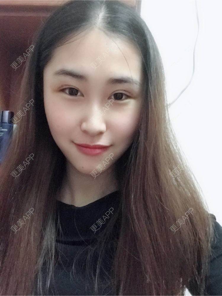 更美 - 陈丽勇 医生的全切双眼皮经验 | 全切双眼皮 | 厦门