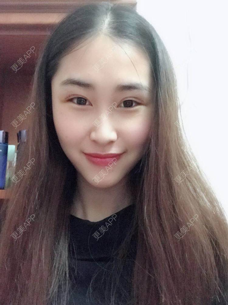 更美 - 陈丽勇 医生的全切双眼皮经验 | 全切双眼皮 | 厦门