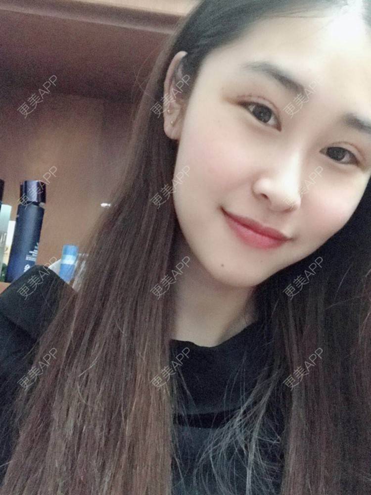 更美 - 陈丽勇 医生的全切双眼皮经验 | 全切双眼皮 | 厦门