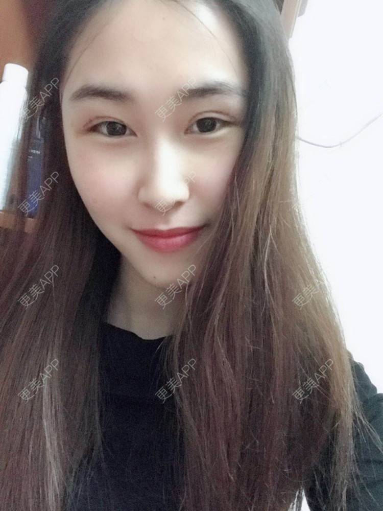 更美 - 陈丽勇 医生的全切双眼皮经验 | 全切双眼皮 | 厦门