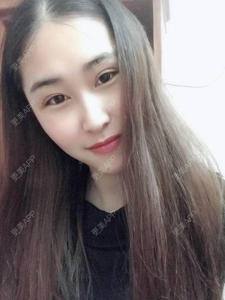 更美 - 陈丽勇 医生的全切双眼皮经验 | 全切双眼皮 | 厦门