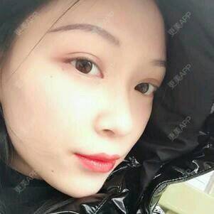 更美 - 黄鹂鸣翠柳的鼻部膨体假体取出经验 | 鼻部膨体假体取出 | 温州