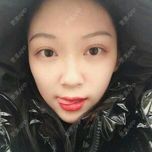 更美 - 黄鹂鸣翠柳的鼻部膨体假体取出经验 | 鼻部膨体假体取出 | 温州