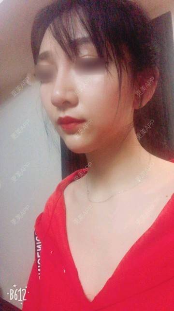 更美用户Gz1GPA3Nzl的隆鼻