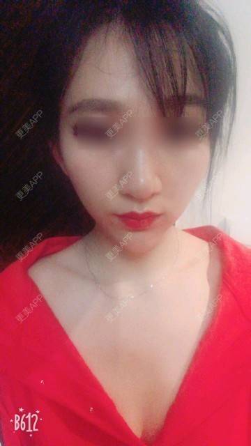 更美用户Gz1GPA3Nzl的隆鼻