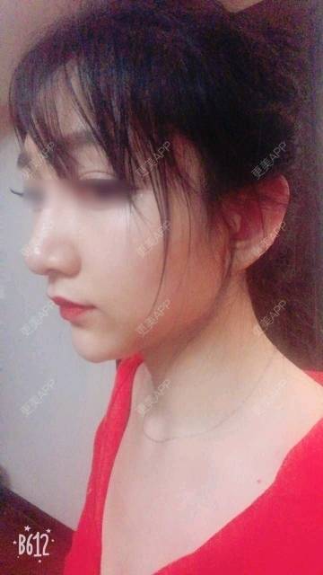 更美用户Gz1GPA3Nzl的隆鼻