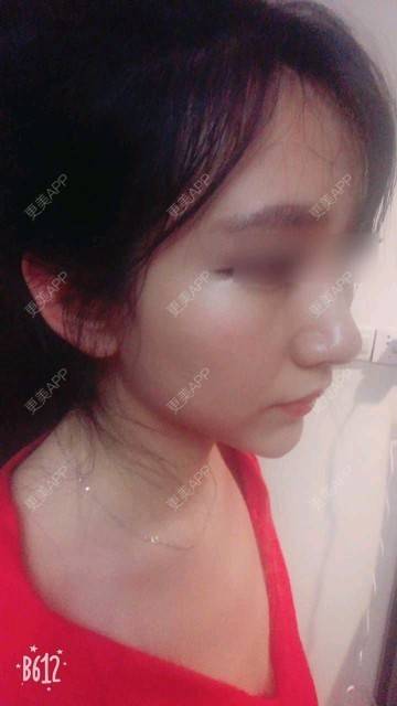 更美用户Gz1GPA3Nzl的隆鼻