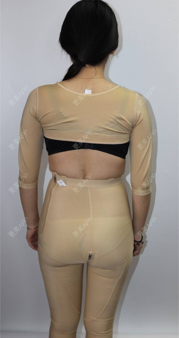 更美用户qhqym0fymh的腰腹吸脂日记