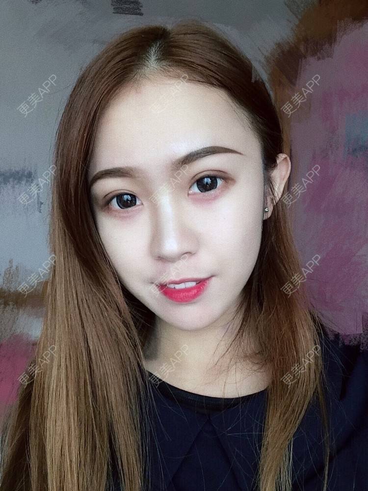 忒自己的双眼皮日记