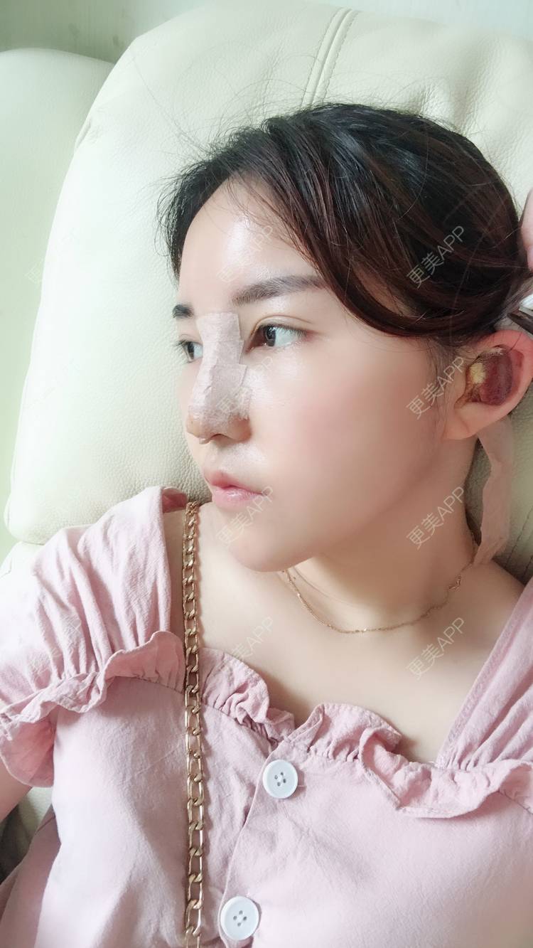 更美用户eqbukttklh的硅胶隆鼻日记