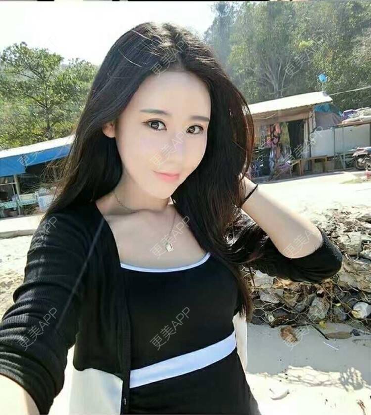 更美 - 我爱吃芝麻的经验 | 吸脂 | 武汉 | 自体脂肪垫下巴