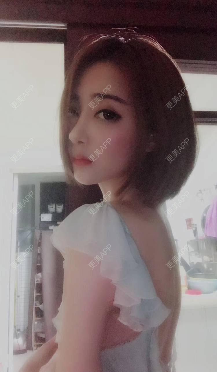 更美 - 莹莹D緈諨的鼻部多项经验 | 视频日记 | 隆鼻 | 鼻部多项 | 膨体隆鼻 | 广州 | 驼峰鼻矫正 | 鼻形态修复