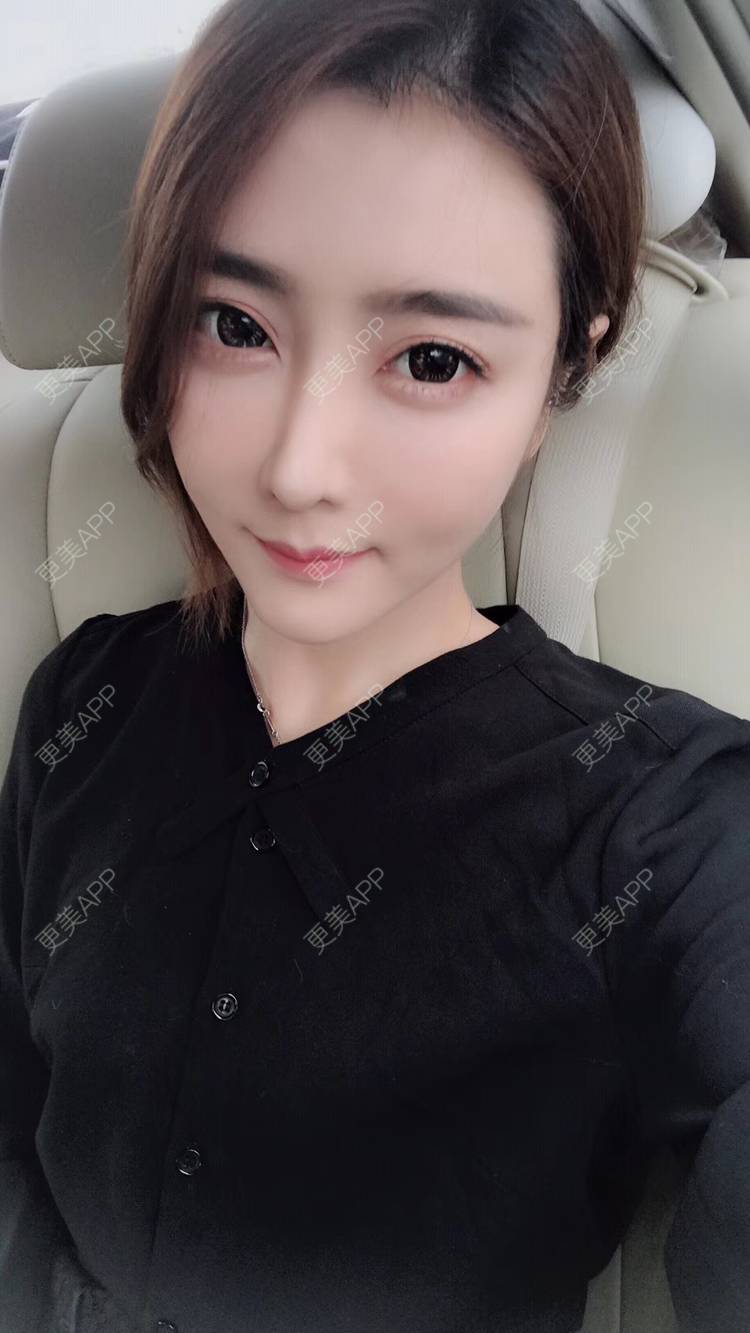 更美 - 莹莹D緈諨的鼻部多项经验 | 视频日记 | 隆鼻 | 鼻部多项 | 膨体隆鼻 | 广州 | 驼峰鼻矫正 | 鼻形态修复