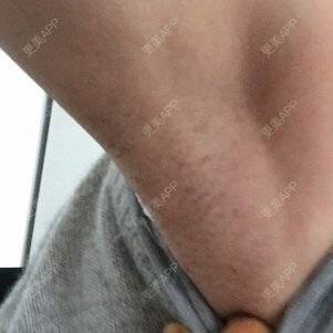 更美 - 更美用户kqsvgAyAZ0的激光脱腋毛经验 | 广州 | 激光脱腋毛