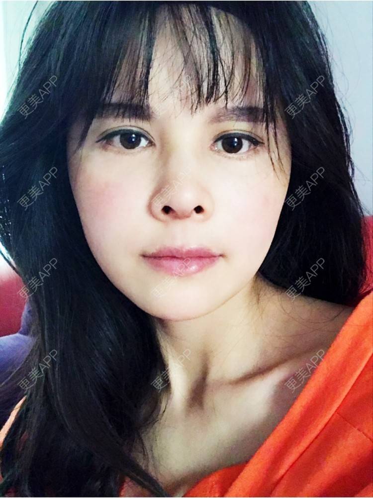 更美 - 喵星球上的女王的鼻翼缩小经验 | 北京 | 朝天鼻矫正手术 | 鼻翼缩小